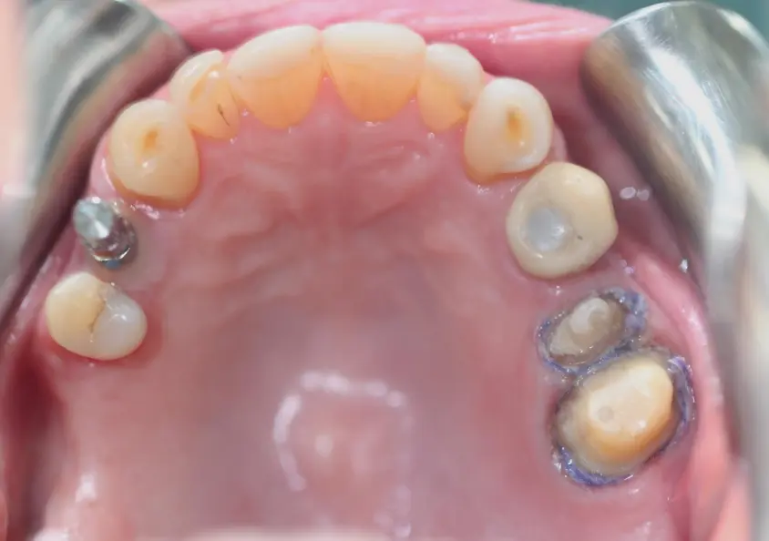 CLINICAL CASES:PERFIT IMPRESSION MATERIALS