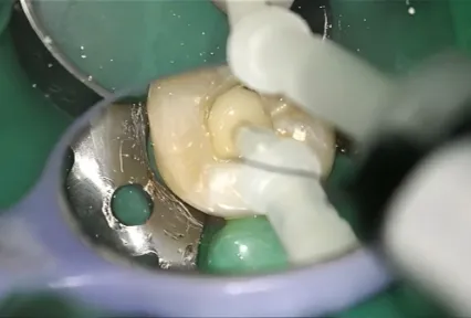 Reliable Posterior Core Build-up with UltraCore:  Clinical Case on Tooth #37